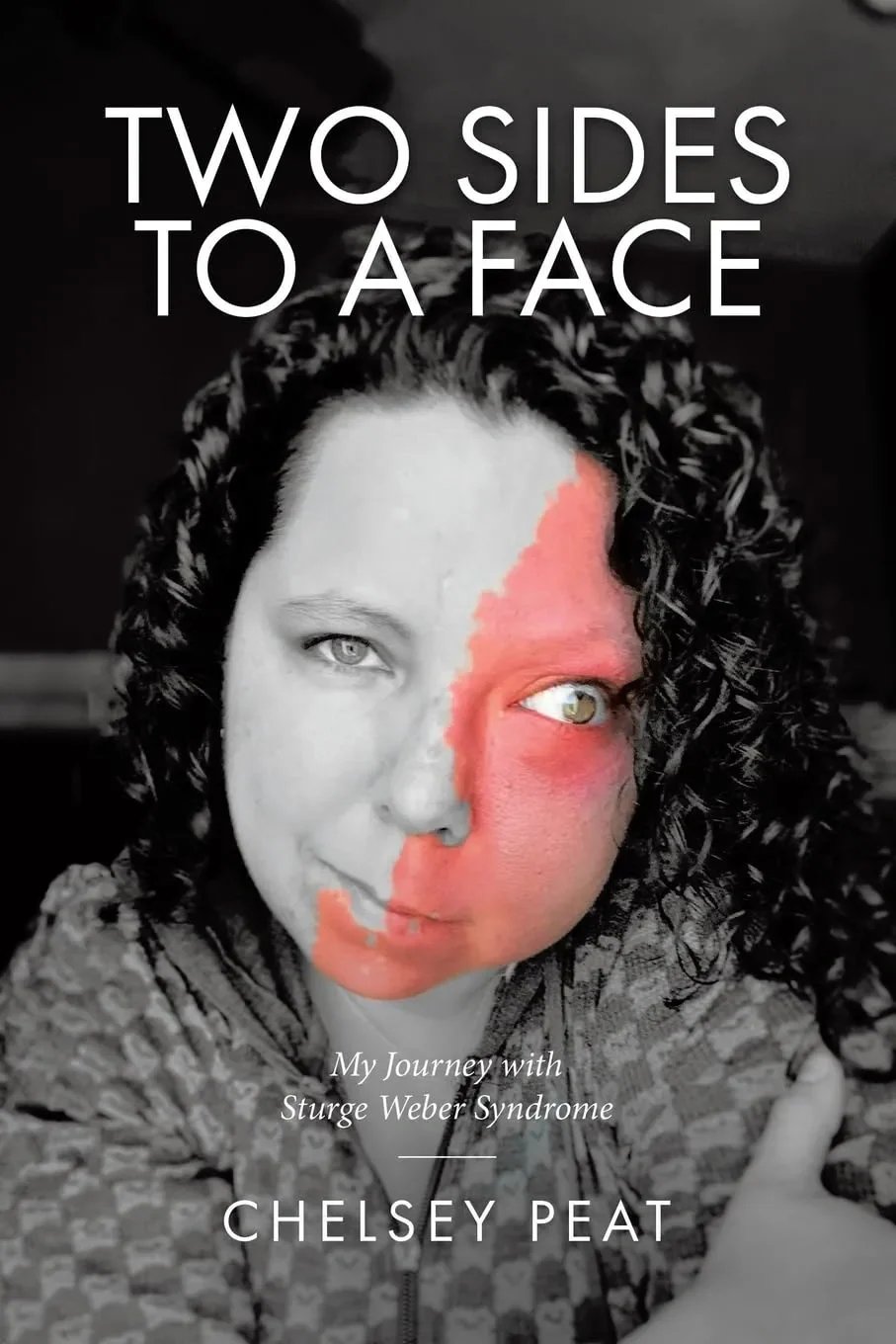 Two Sides to A Face: My Journey with Sturge-Weber Syndrome